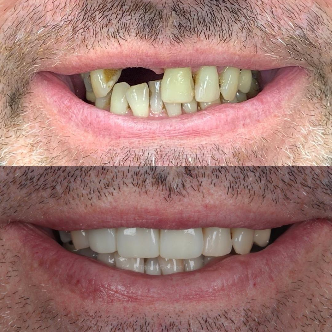 Before and after treatment