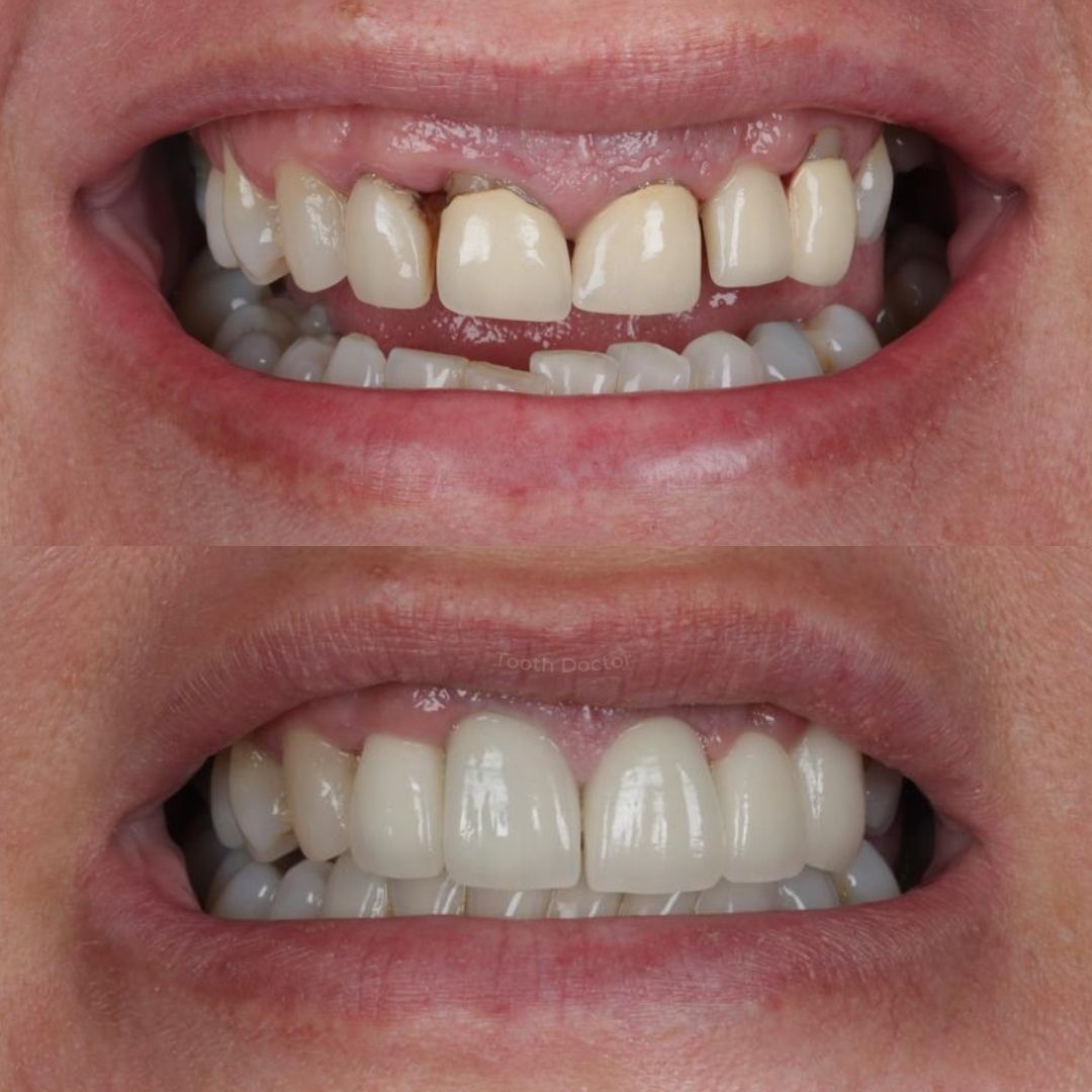 Tooth Doctor | Invisalign Retainers Before and after treatment at Tooth Doctor in Carluke