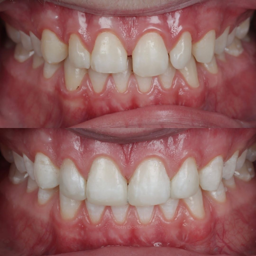 Tooth Doctor | Invisalign Retainers Before and after treatment at Tooth Doctor in Carluke