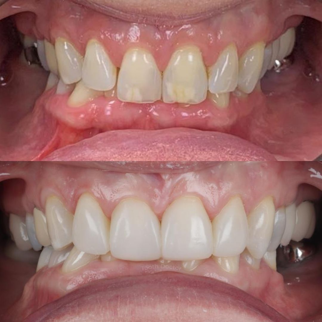 Tooth Doctor | Invisalign Retainers Before and after treatment at Tooth Doctor in Carluke