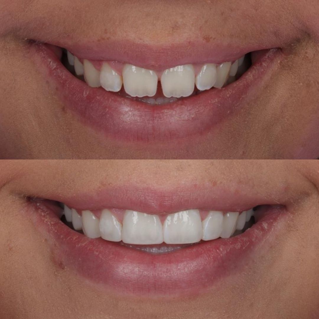 Tooth Doctor | Invisalign Retainers Before and after treatment at Tooth Doctor in Carluke