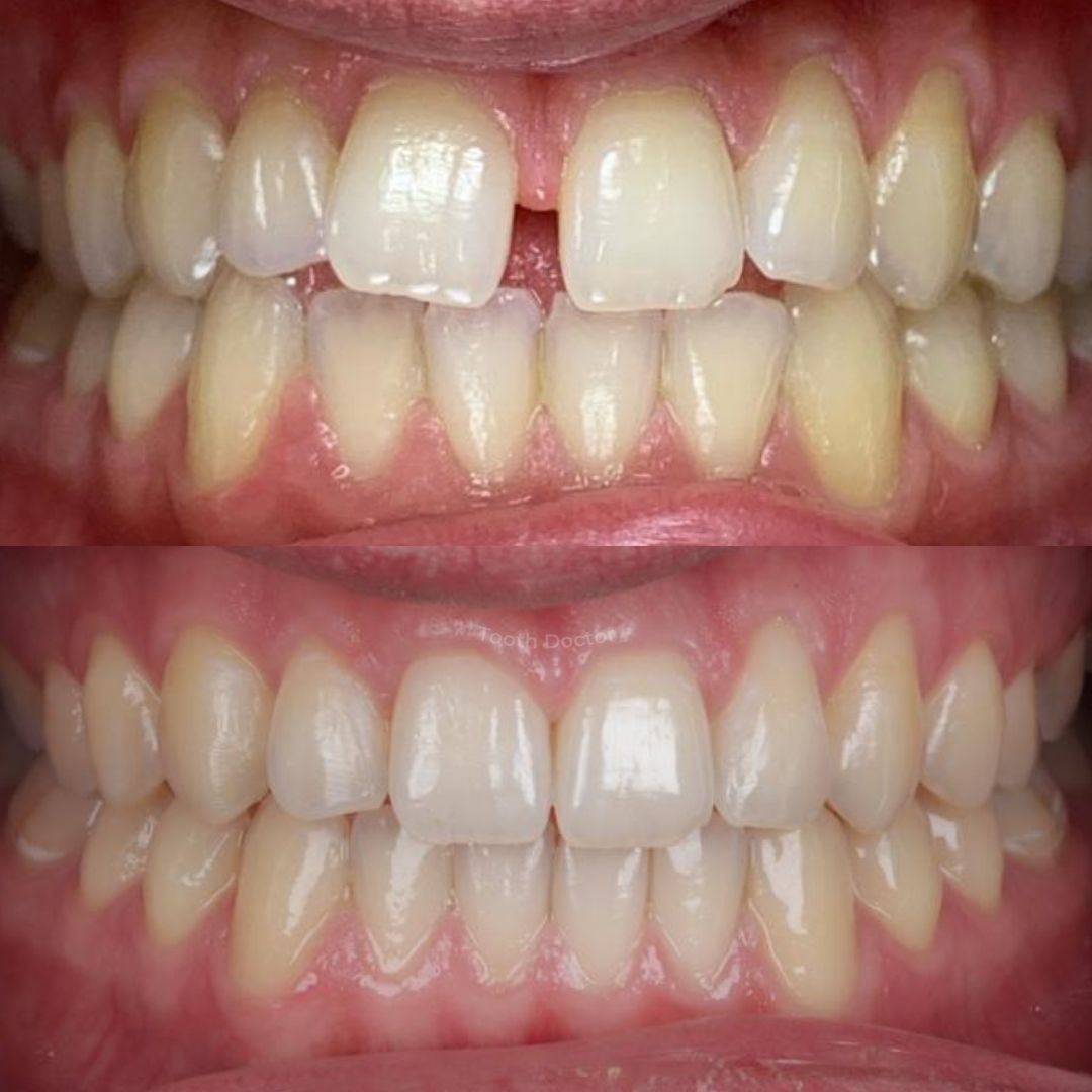 Tooth Doctor | Invisalign Retainers Before and after treatment at Tooth Doctor in Carluke