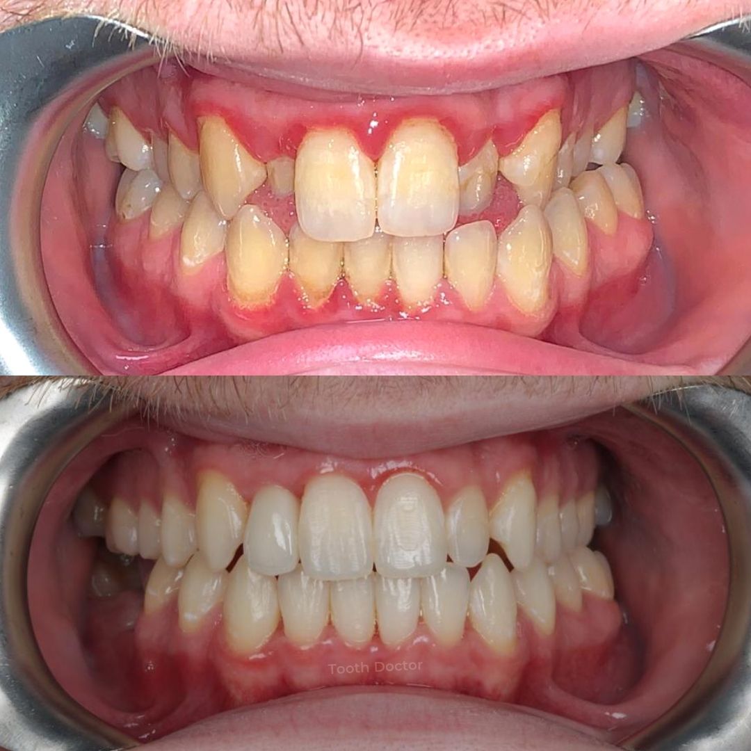 Tooth Doctor | Invisalign Retainers Before and after treatment at Tooth Doctor in Carluke