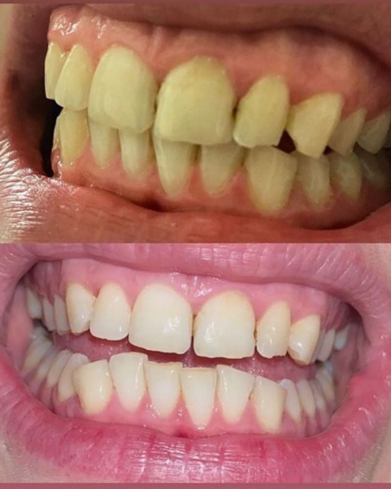 Tooth Doctor | Janice English Before & after treatment with Janice