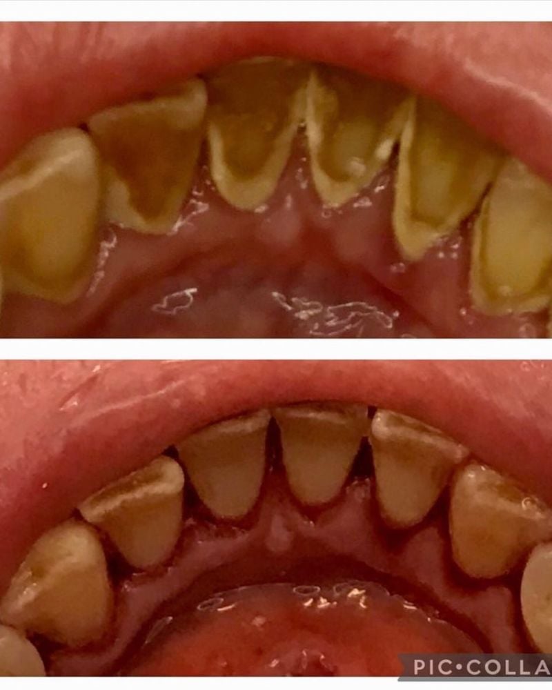 Tooth Doctor | Janice English Before & after treatment with Janice