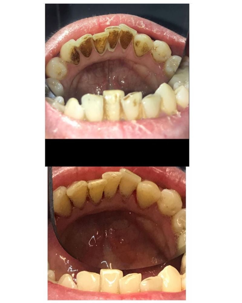 Tooth Doctor | Janice English Before & after treatment with Janice