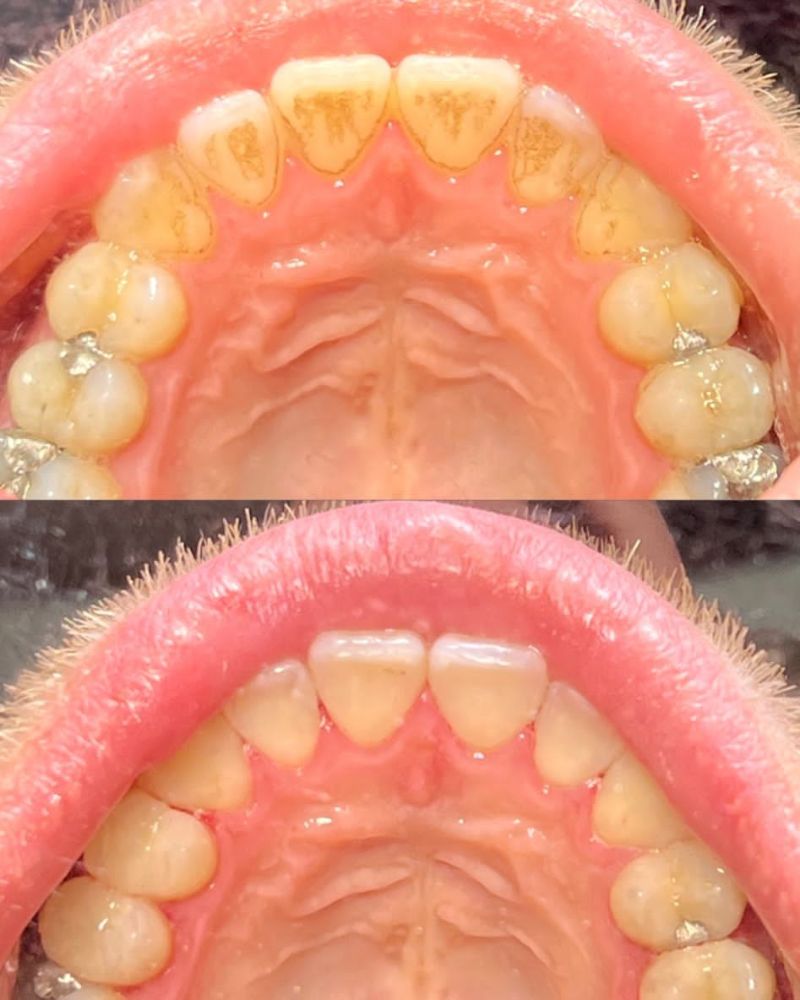 Before & after treatment with Kelly