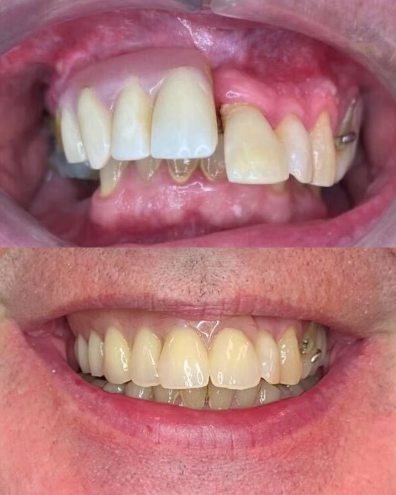Before & after treatment with Sofia
