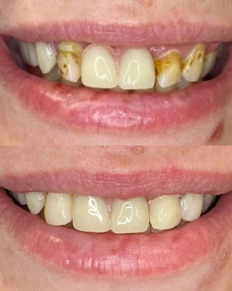 Before & after treatment with Sofia