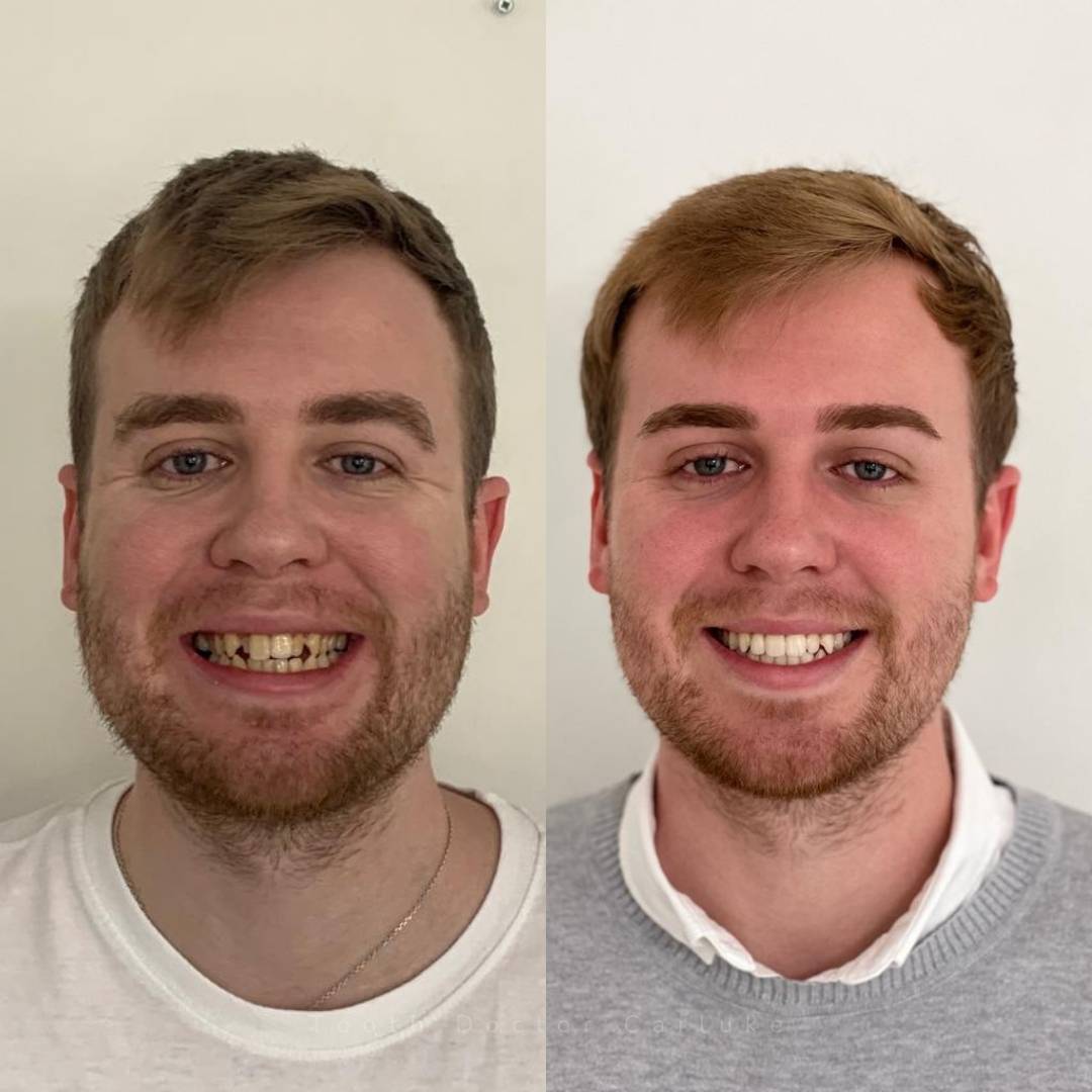 Before and after treatment