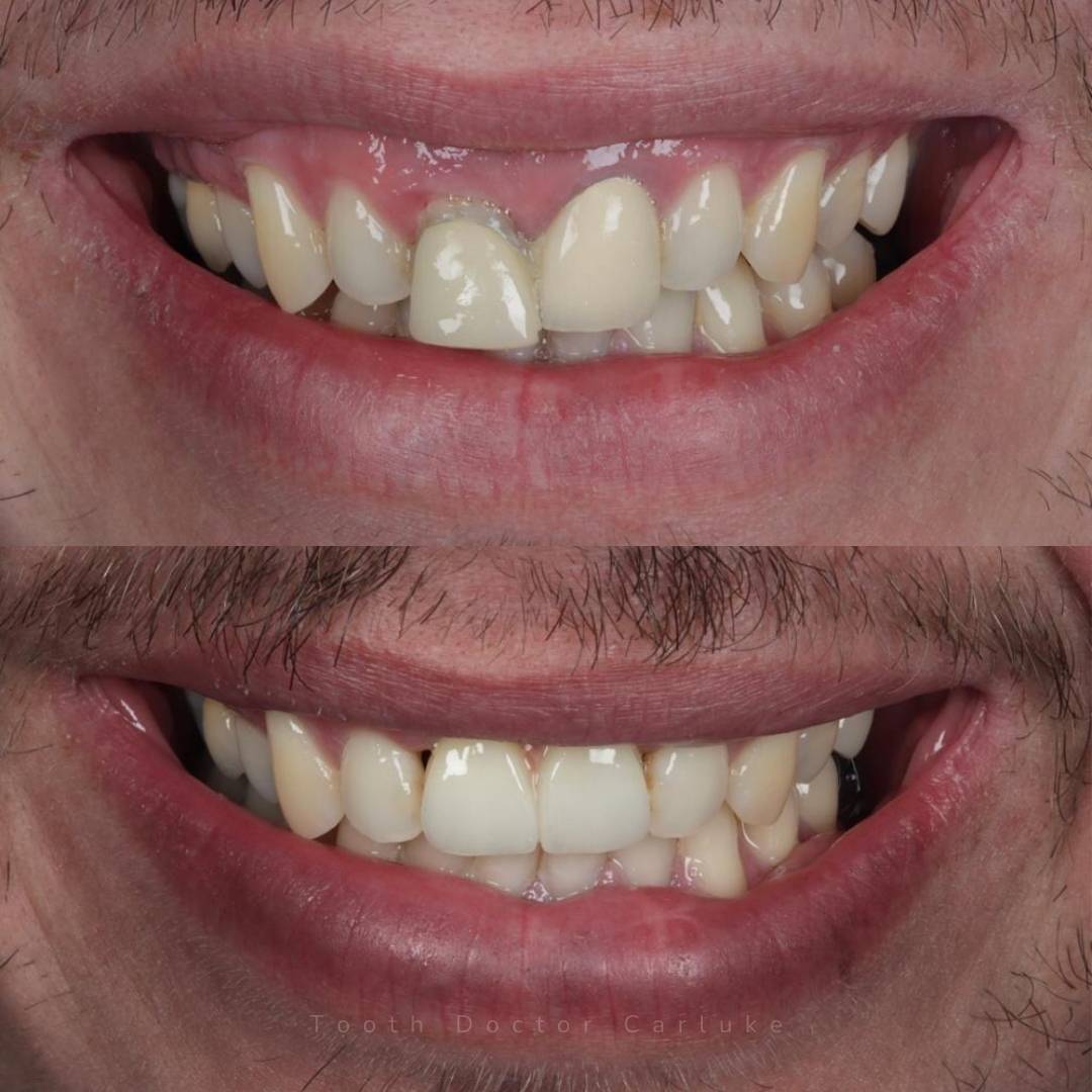 Tooth Doctor | Invisalign Retainers Tooth Doctor | Invisalign Retainers