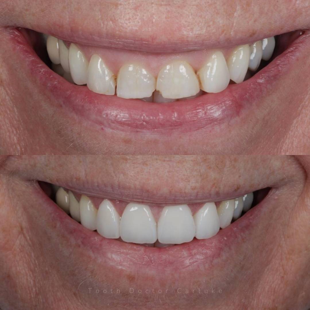 Tooth Doctor | Invisalign Retainers Tooth Doctor | Invisalign Retainers