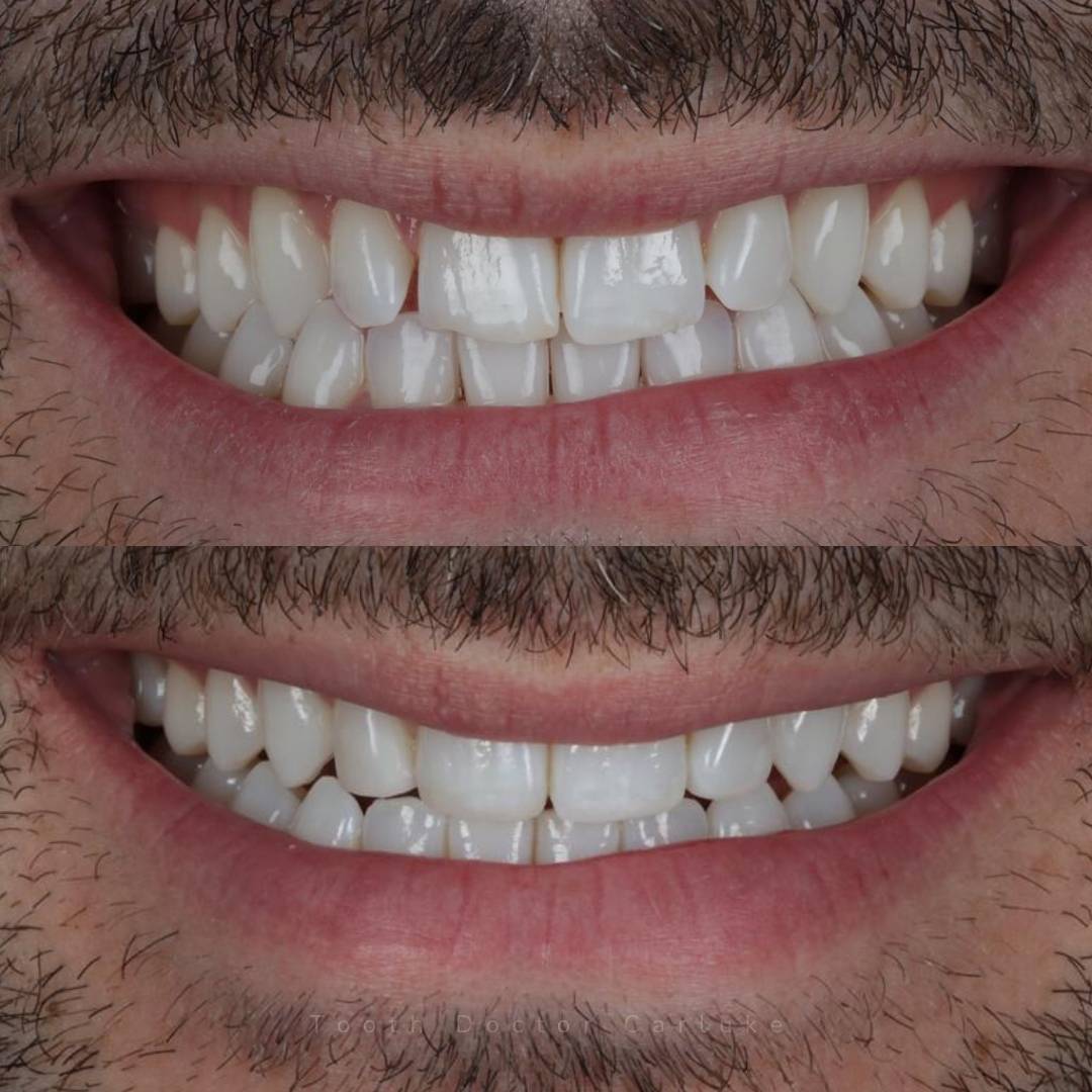 Tooth Doctor | Invisalign Retainers Tooth Doctor | Invisalign Retainers