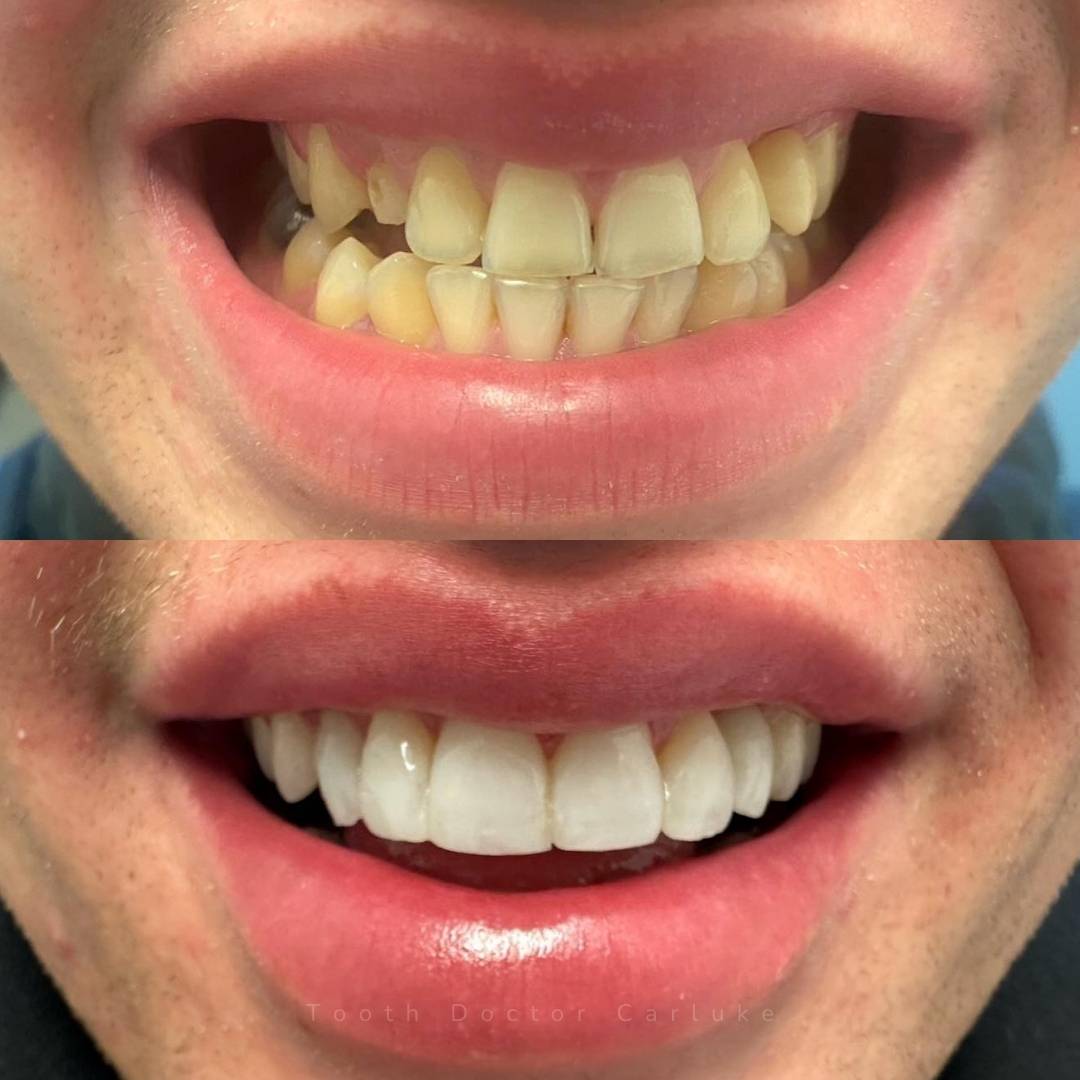 Tooth Doctor | Invisalign Retainers Tooth Doctor | Invisalign Retainers