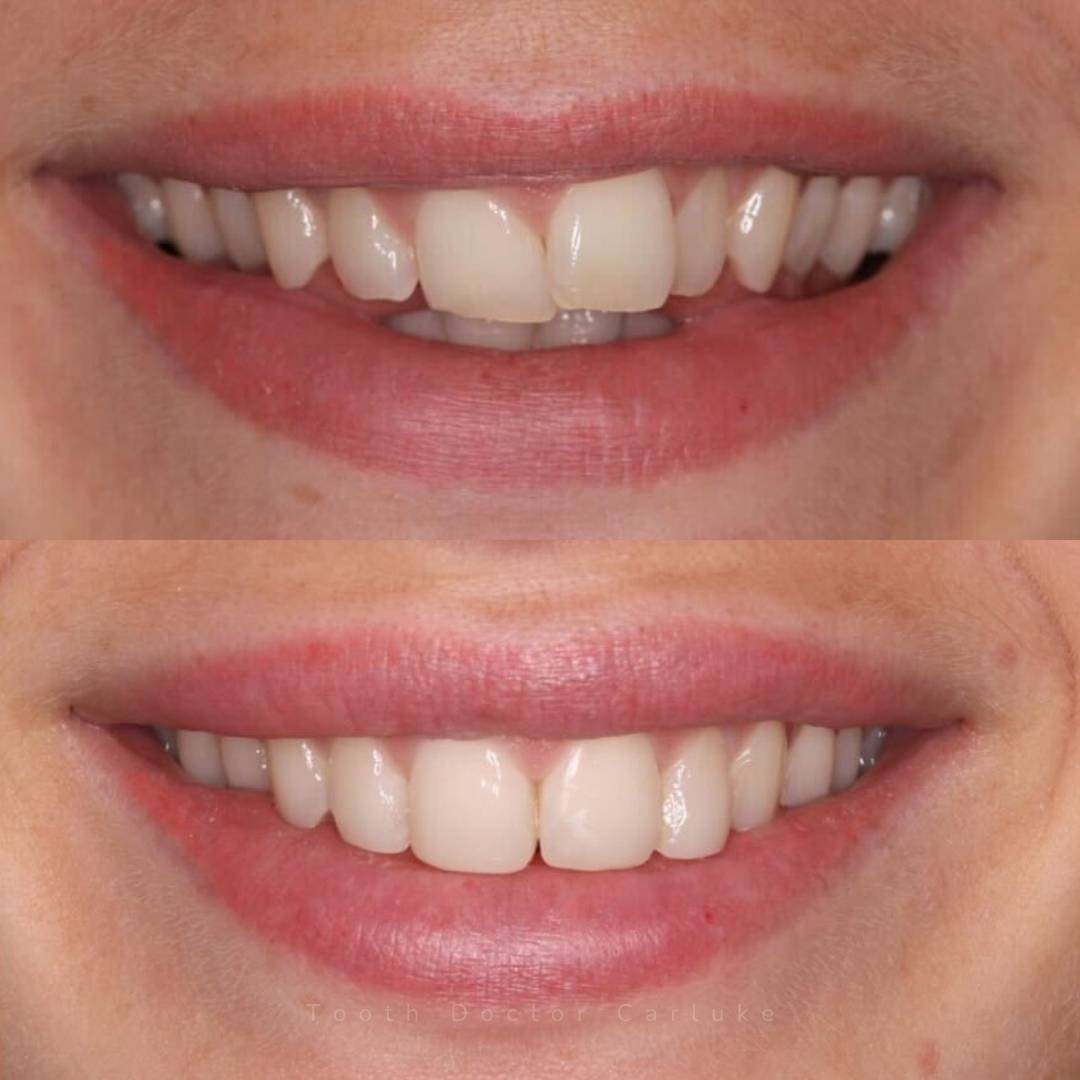 Tooth Doctor | Invisalign Retainers Tooth Doctor | Invisalign Retainers