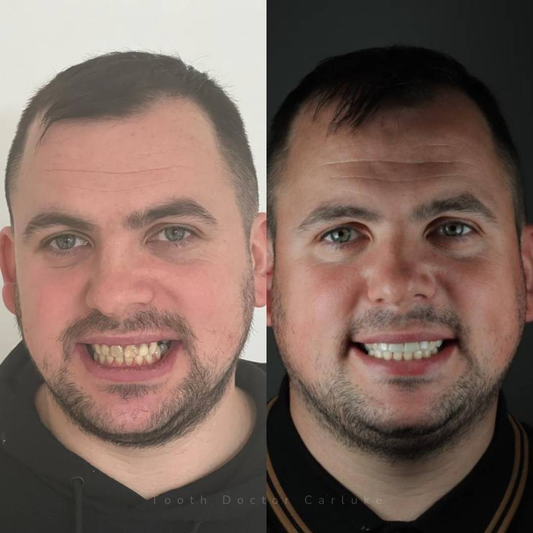Before and after treatment