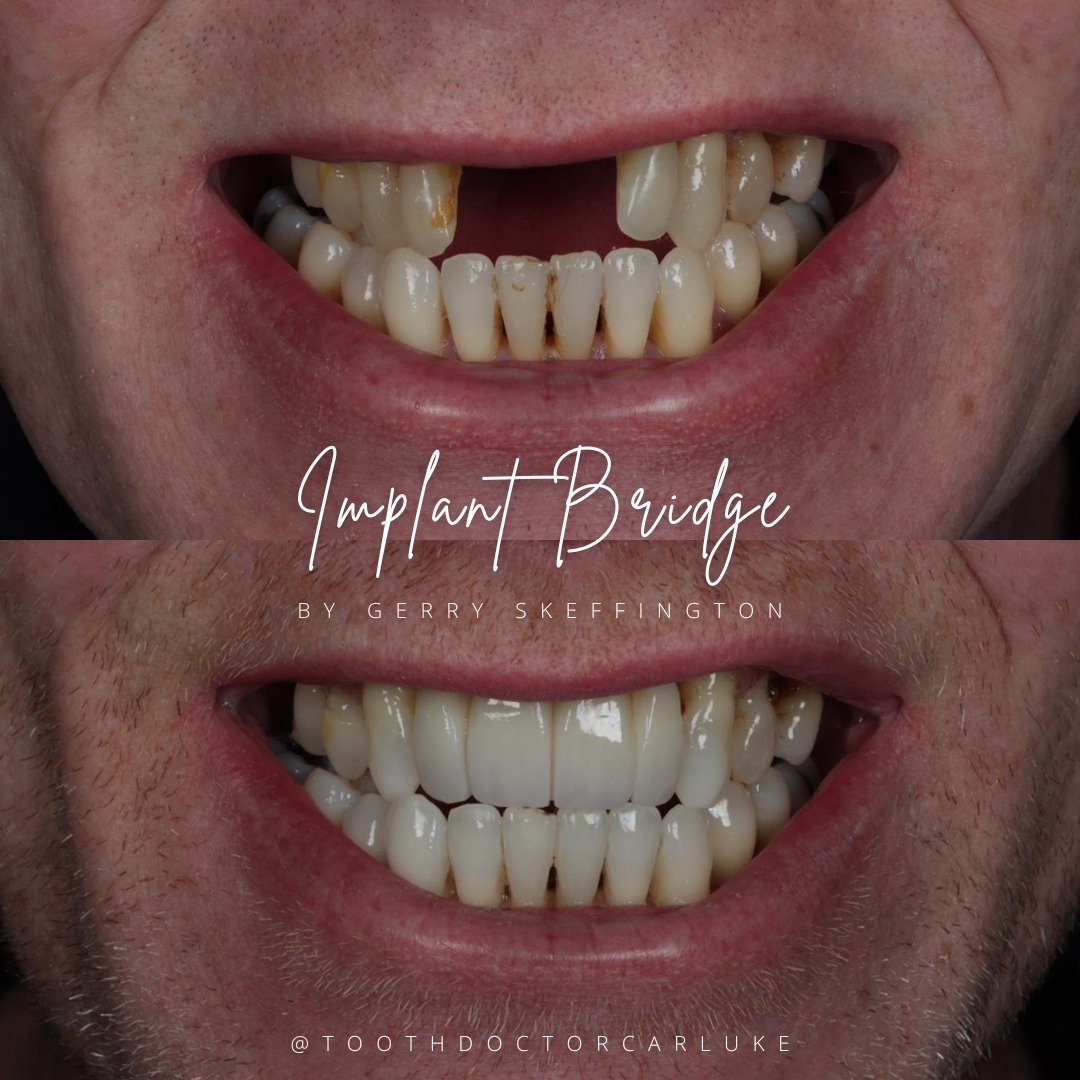 Tooth Doctor | Dental Implants Carluke Replace Missing Teeth Tooth Doctor | Dental Implants Carluke Replace Missing Teeth