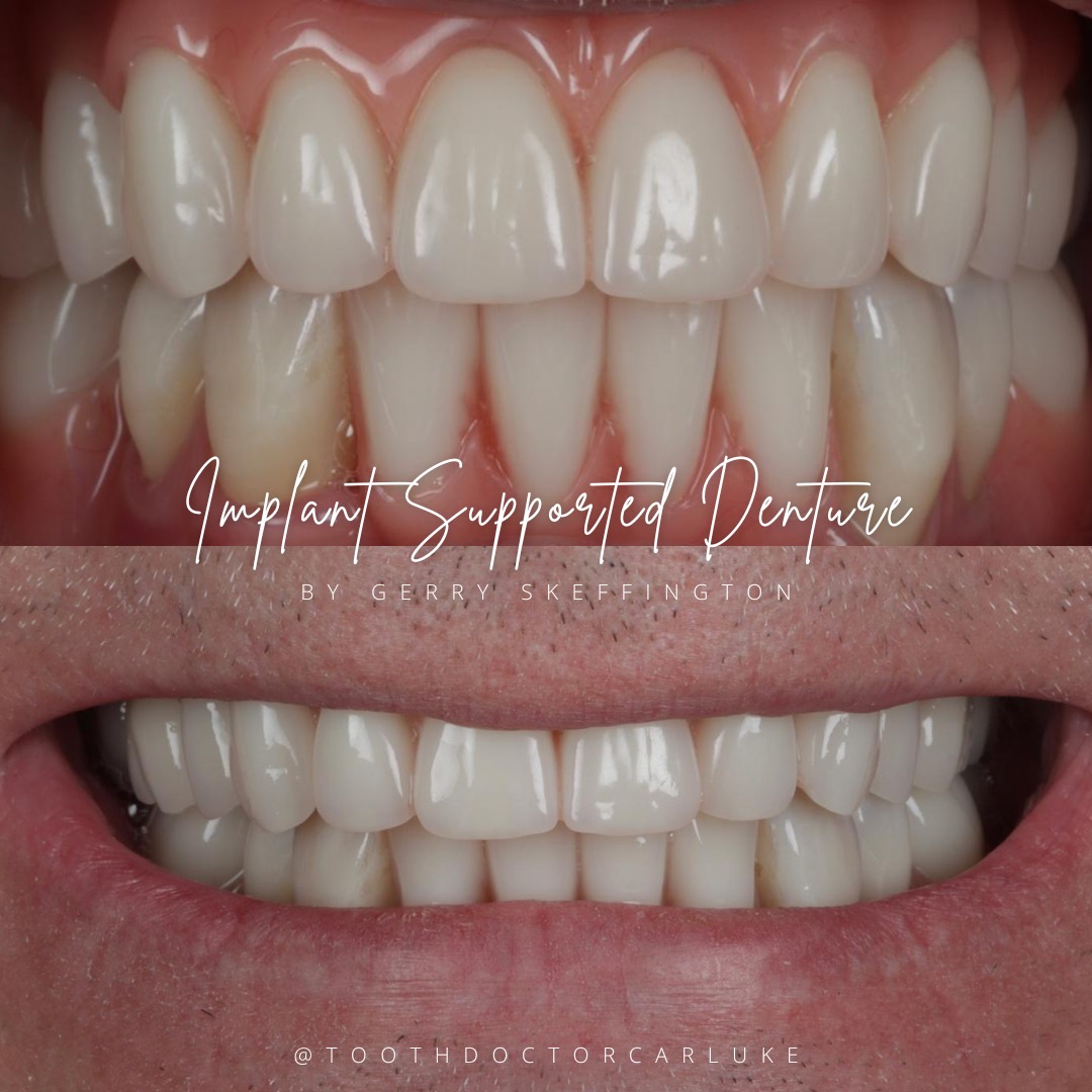 Tooth Doctor | Dental Implants Carluke Replace Missing Teeth Tooth Doctor | Dental Implants Carluke Replace Missing Teeth