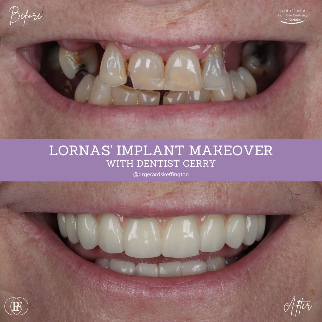 Tooth Doctor | Lorna's Implant Makeover Lorna's Smile Story with Gerry