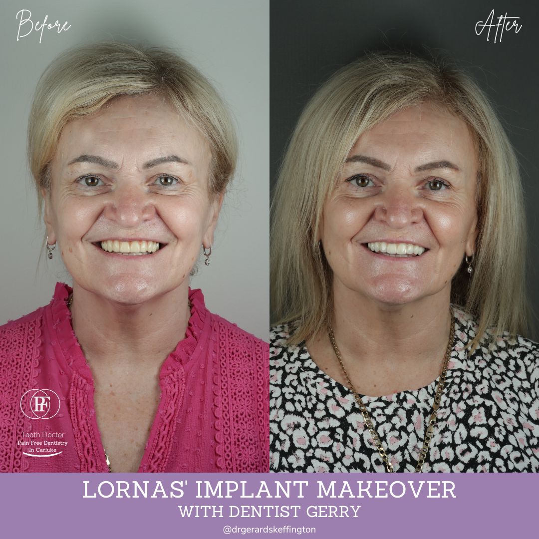 Tooth Doctor | Lorna's Implant Makeover Tooth Doctor | Lorna's Implant Makeover