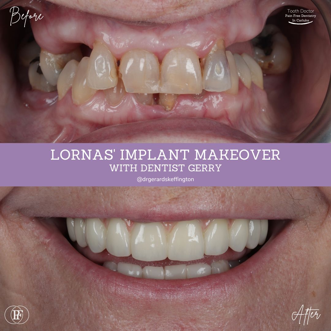 Tooth Doctor | Lorna's Implant Makeover Tooth Doctor | Lorna's Implant Makeover