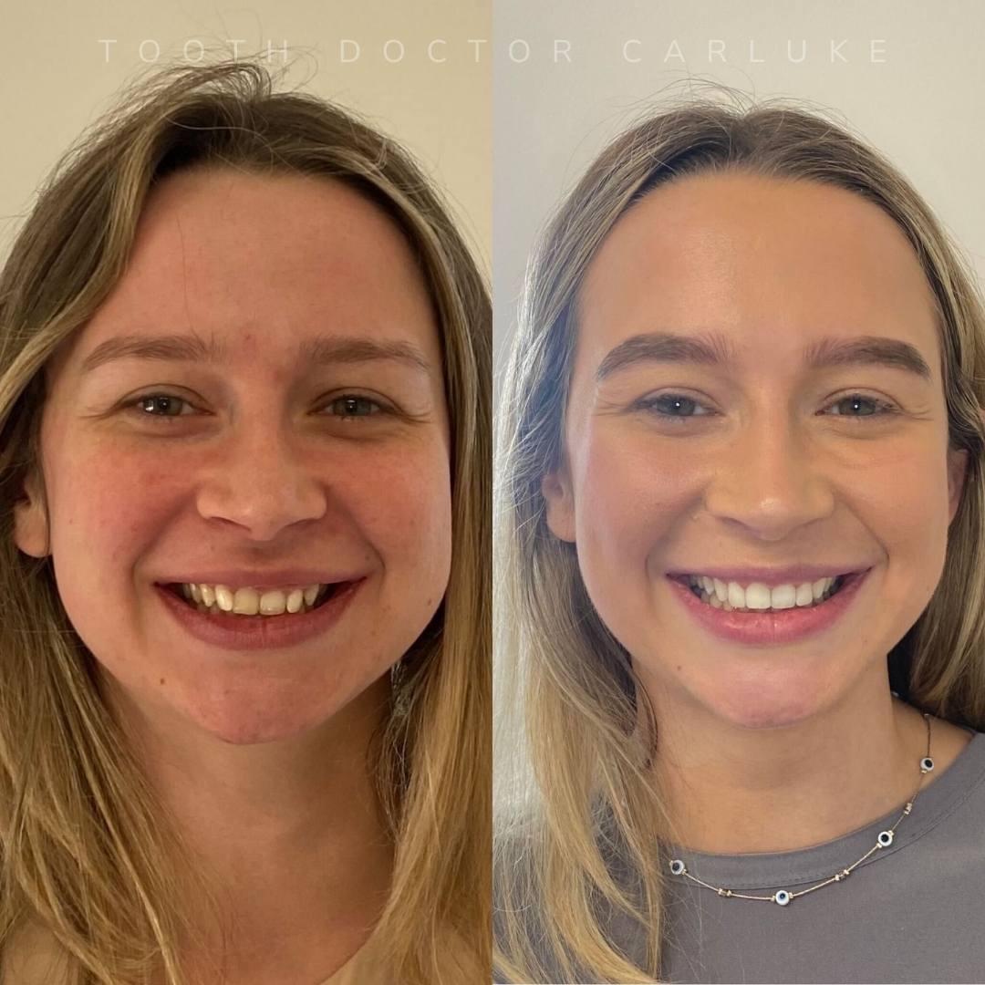 Before and after treatment