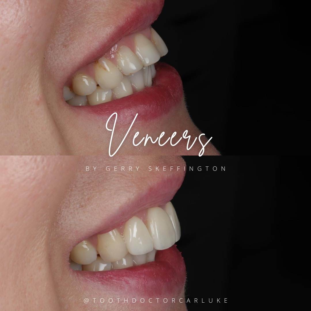 Tooth Doctor | Dental Veneers Tooth Doctor | Dental Veneers