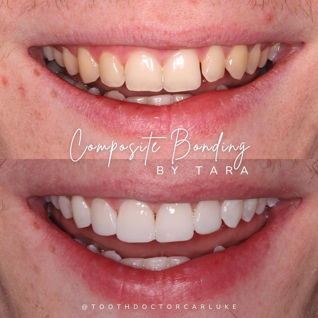 Tooth Doctor | Dental Veneers Tooth Doctor | Dental Veneers