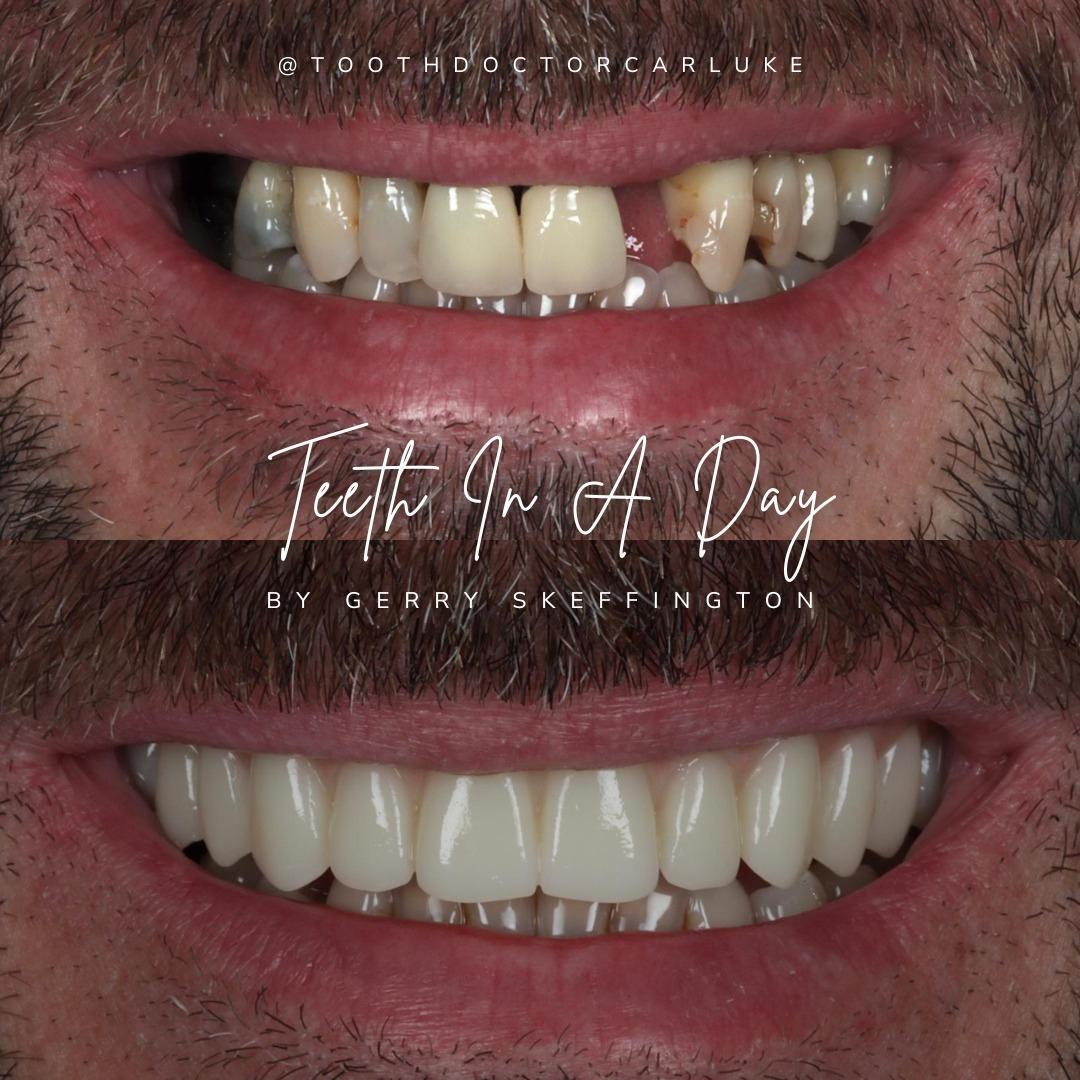 Tooth Doctor | Dental Implants Carluke Replace Missing Teeth Dental Implants Treatment