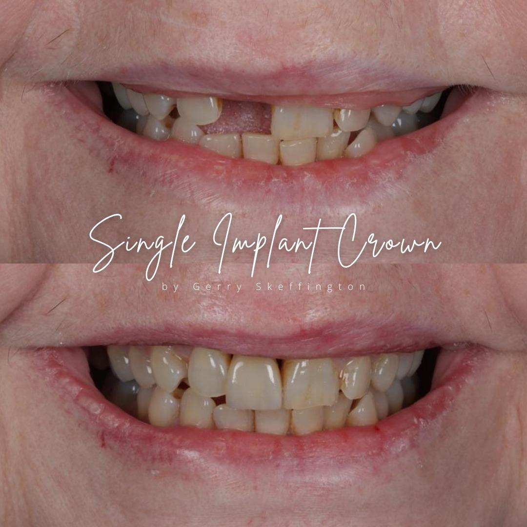 Tooth Doctor | Dental Implants Carluke Replace Missing Teeth Dental Implants Treatment