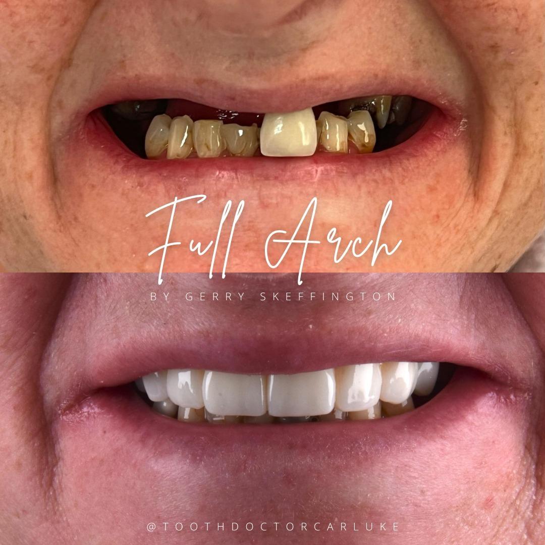 Tooth Doctor | Dental Implants Carluke Replace Missing Teeth Dental Implants Treatment