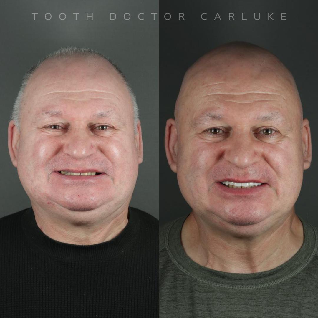 Tooth Doctor | Dental Implants Carluke Replace Missing Teeth We used an implant bridge to replace failing crowns and to create this lovely looking smile