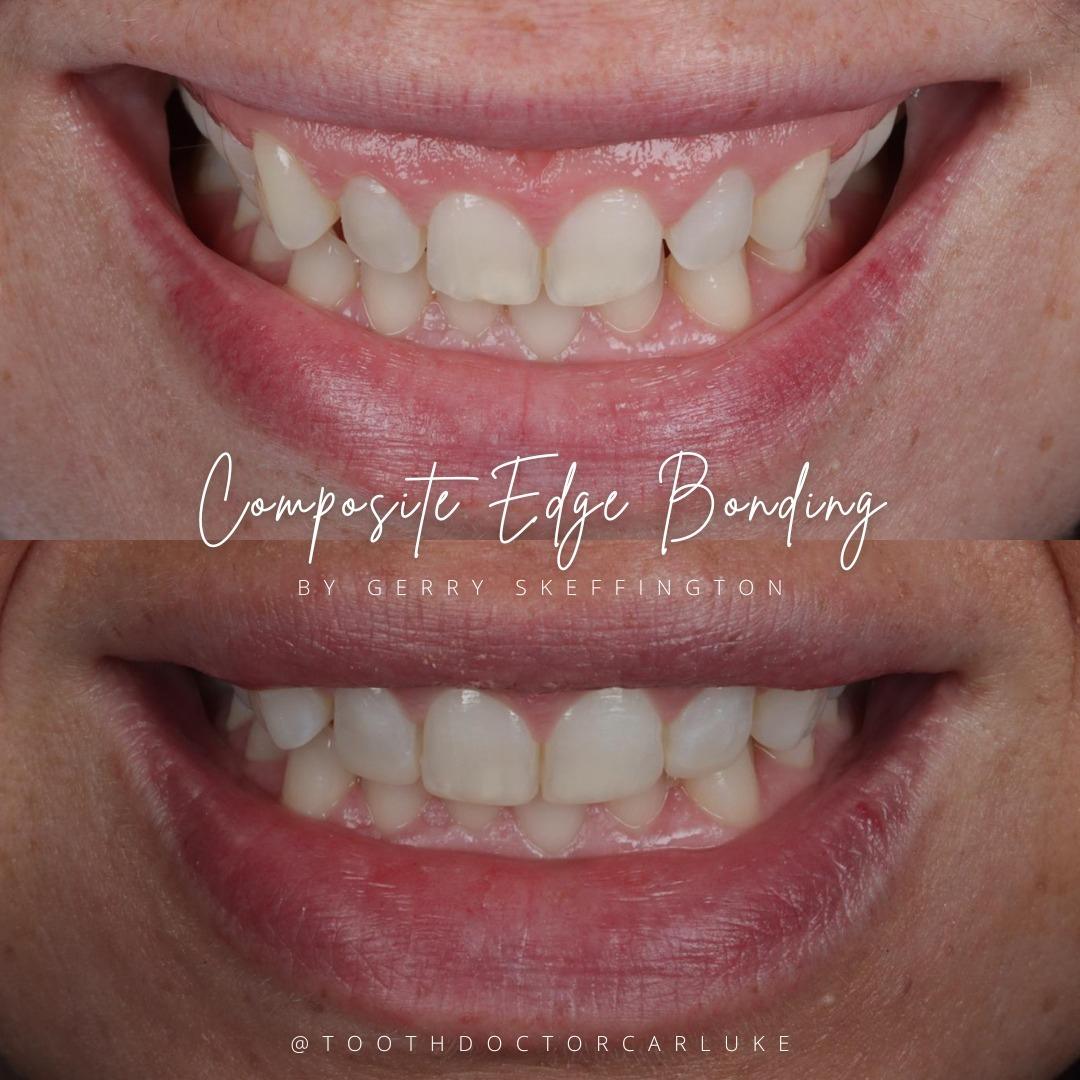 Tooth Doctor | Dental Veneers Tooth Doctor | Dental Veneers