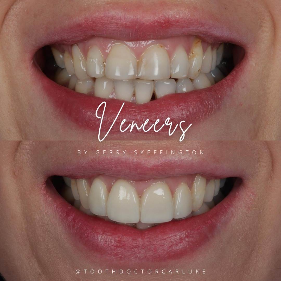 Tooth Doctor | Dental Veneers Results from clear aligners, hygiene treatment and porcelain veneer by Gerry. And it was all done in a pain free manner