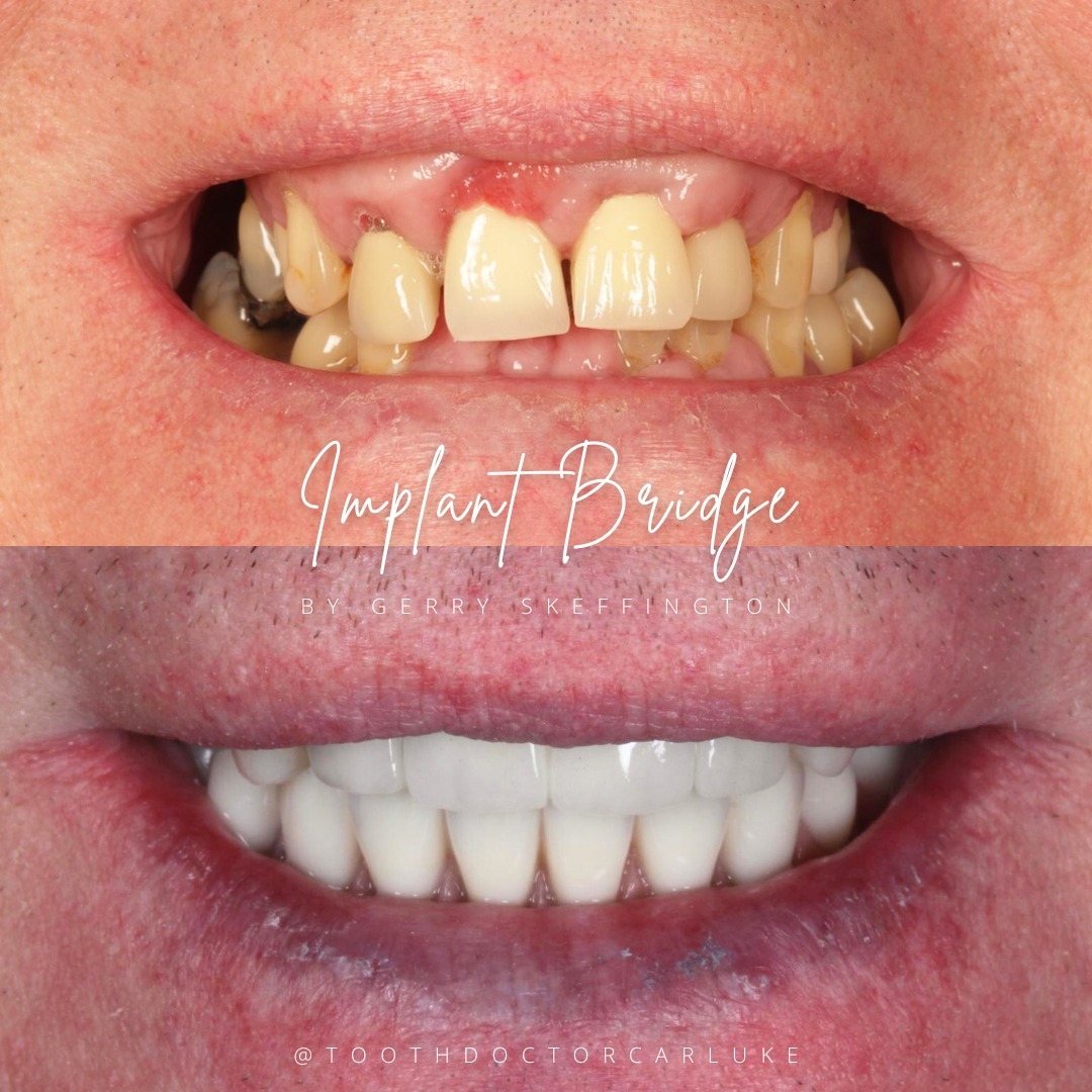 Before and after treatment at Tooth Doctor in Carluke