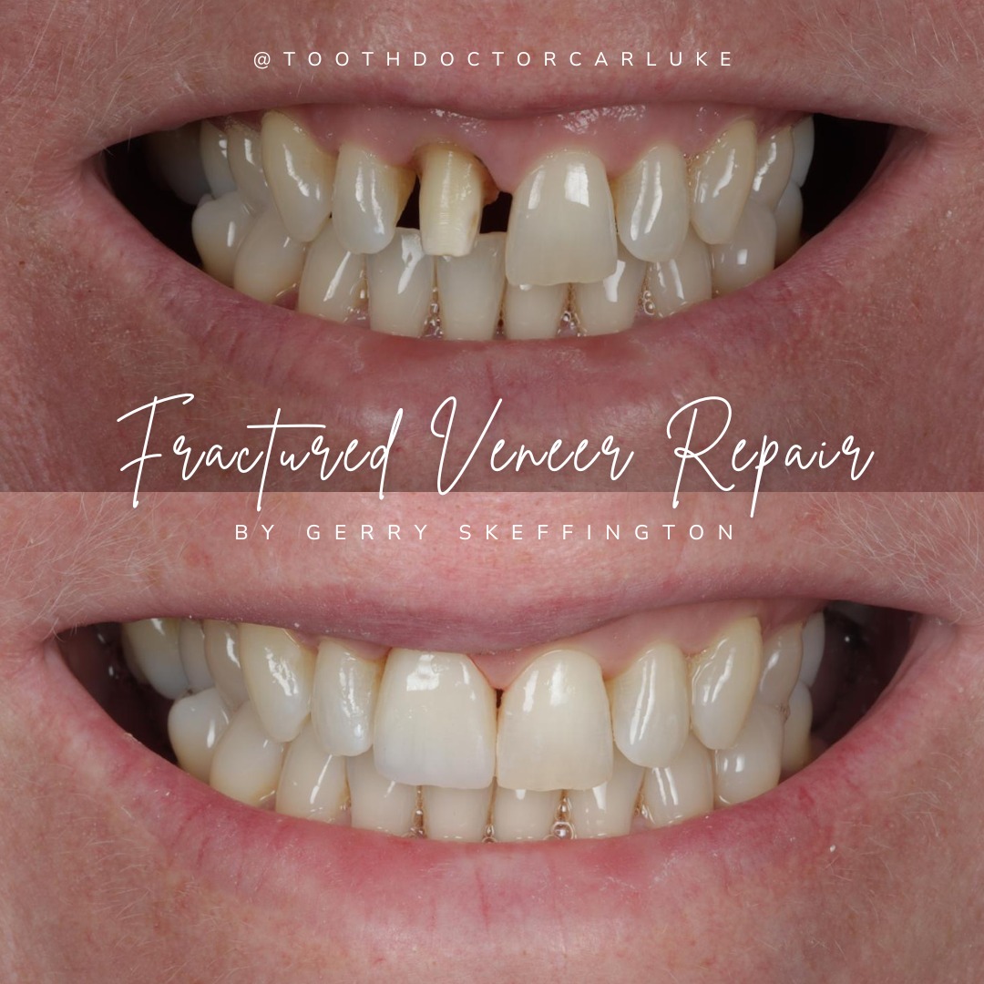 Tooth Doctor | Dental Veneers Tooth Doctor | Dental Veneers