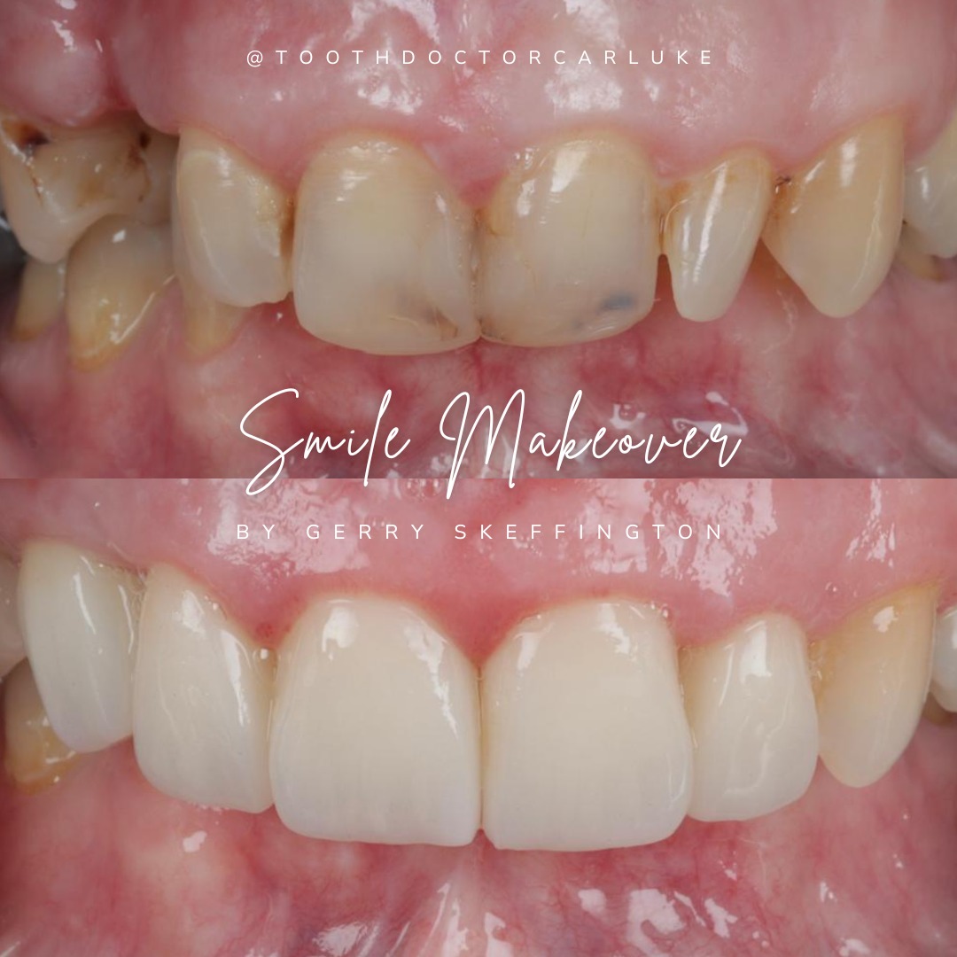 Tooth Doctor | Dental Veneers Tooth Doctor | Dental Veneers