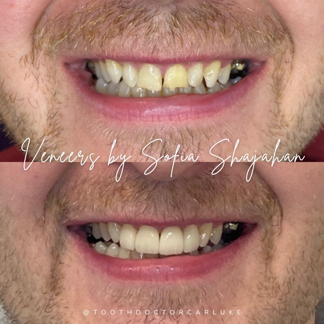 Tooth Doctor | Dental Veneers Tooth Doctor | Dental Veneers
