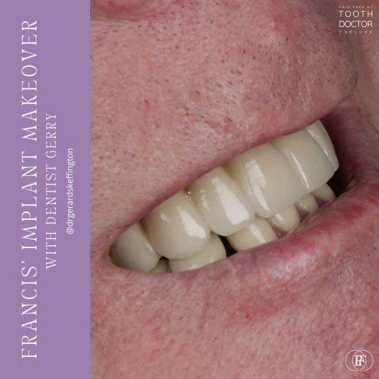Tooth Doctor | Francis Calderhead's Implant Makeover Tooth Doctor | Francis Calderhead's Implant Makeover