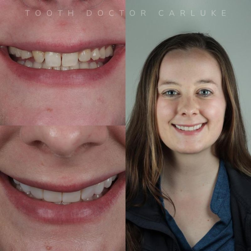 Tooth Doctor | Composite Treatments What Are Composite Veneers?