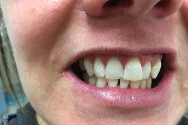 Tooth Doctor | Teeth Whitening Stain Removal After Enlighten Whitening