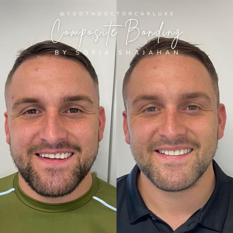 Tooth Doctor | Composite Treatments What Is Composite Bonding?